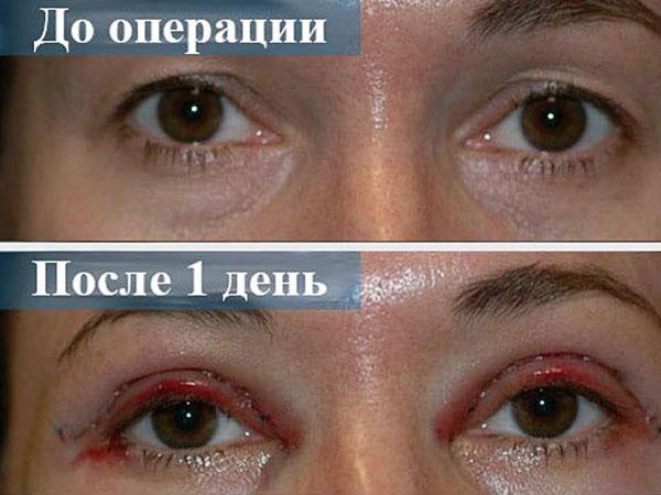 круговая блефаропластика