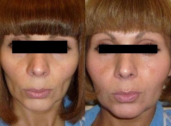 липофилинг лица до и после