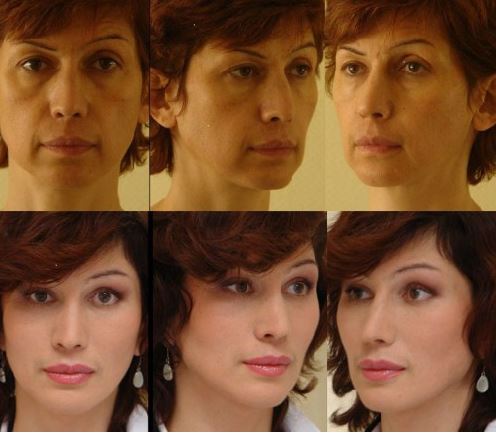 липофилинг лица до и после