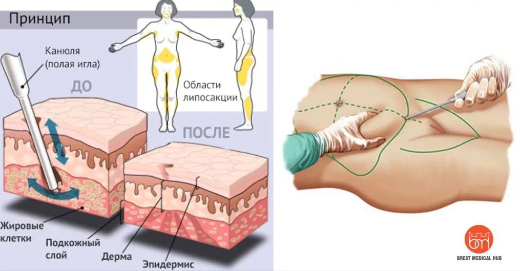 липосакция живота