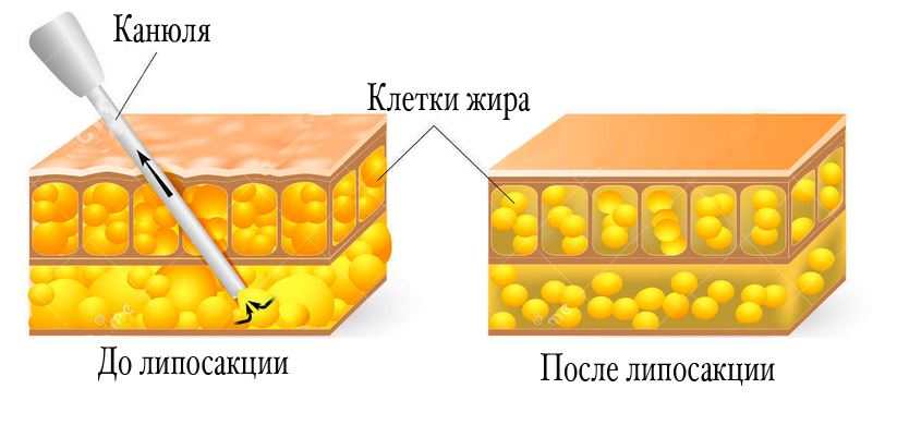 липосакция живота