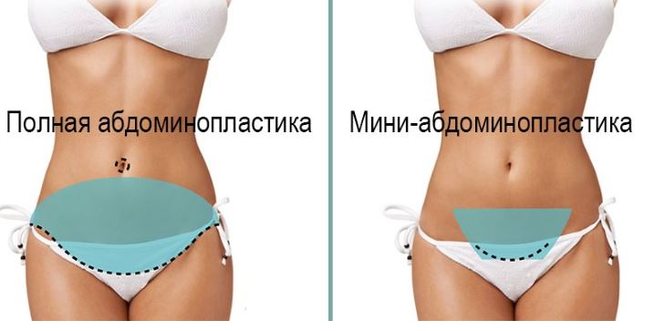 абдоминопластика живота